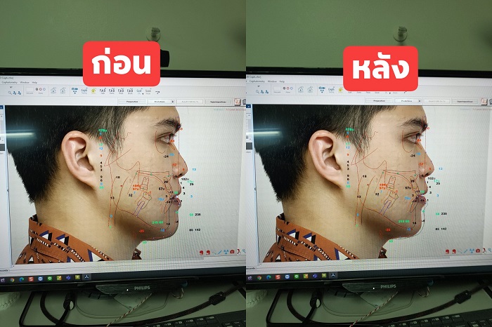 ผ่าตัดขากรรไกร ผ่าขากรรไกร ผ่าตัดขากรรไกรที่ไหนดี แก้ฟันล่างคร่อมฟันบน