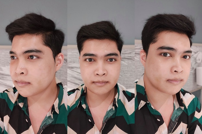 ผ่าตัดขากรรไกร ผ่าขากรรไกร รีวิวเลื่อนขากรรไกร ฟันล่างคร่อมฟันบน