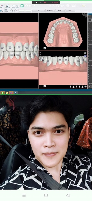 ผ่าตัดขากรรไกร ผ่าขากรรไกรรีวิว ขากรรไกร