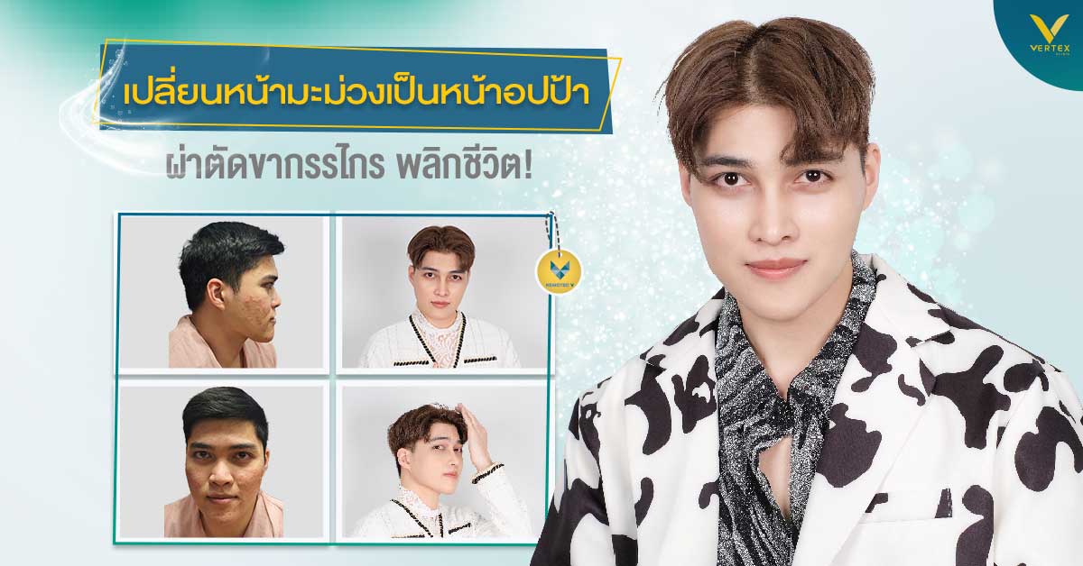 [รีวิวผ่าขากรรไกร+ทำคาง] เปลี่ยนหน้ามะม่วงเป็นหน้าอปป้า ผ่าตัดขากรรไกร พลิกชีวิต!