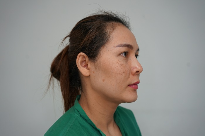 ทำกราม ตัดกราม กราม