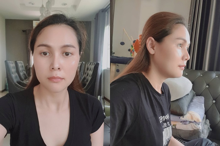 ทำกราม ผ่าตัดกราม ลดกรามถาวร