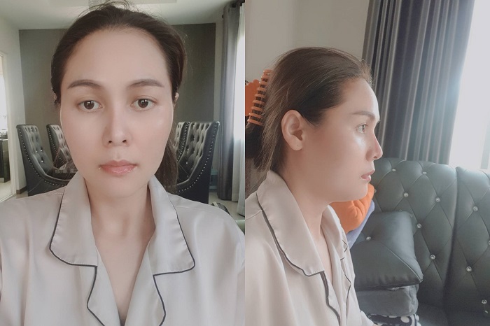 ลดกราม เหลากราม กราม