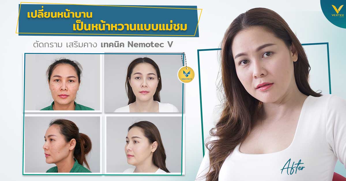 ตัดกราม ผ่ากราม เหลากราม ลดกราม ลดกรามถาวร ผ่าตัดกราม ทำกราม