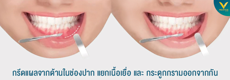 ตัดกรามในช่องปาก