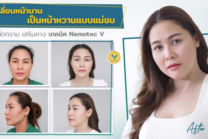 ตัดกราม ผ่ากราม เหลากราม ลดกราม ลดกรามถาวร ผ่าตัดกราม ทำกราม