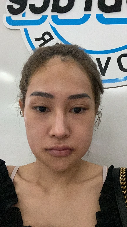 หลังผ่าตัดกราม 1 วัน