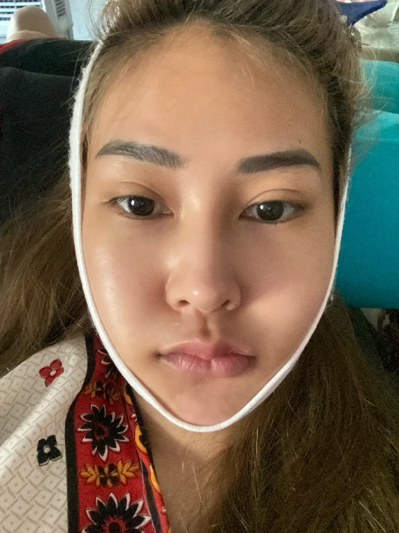 หลังผ่าตัดกราม 3 วัน