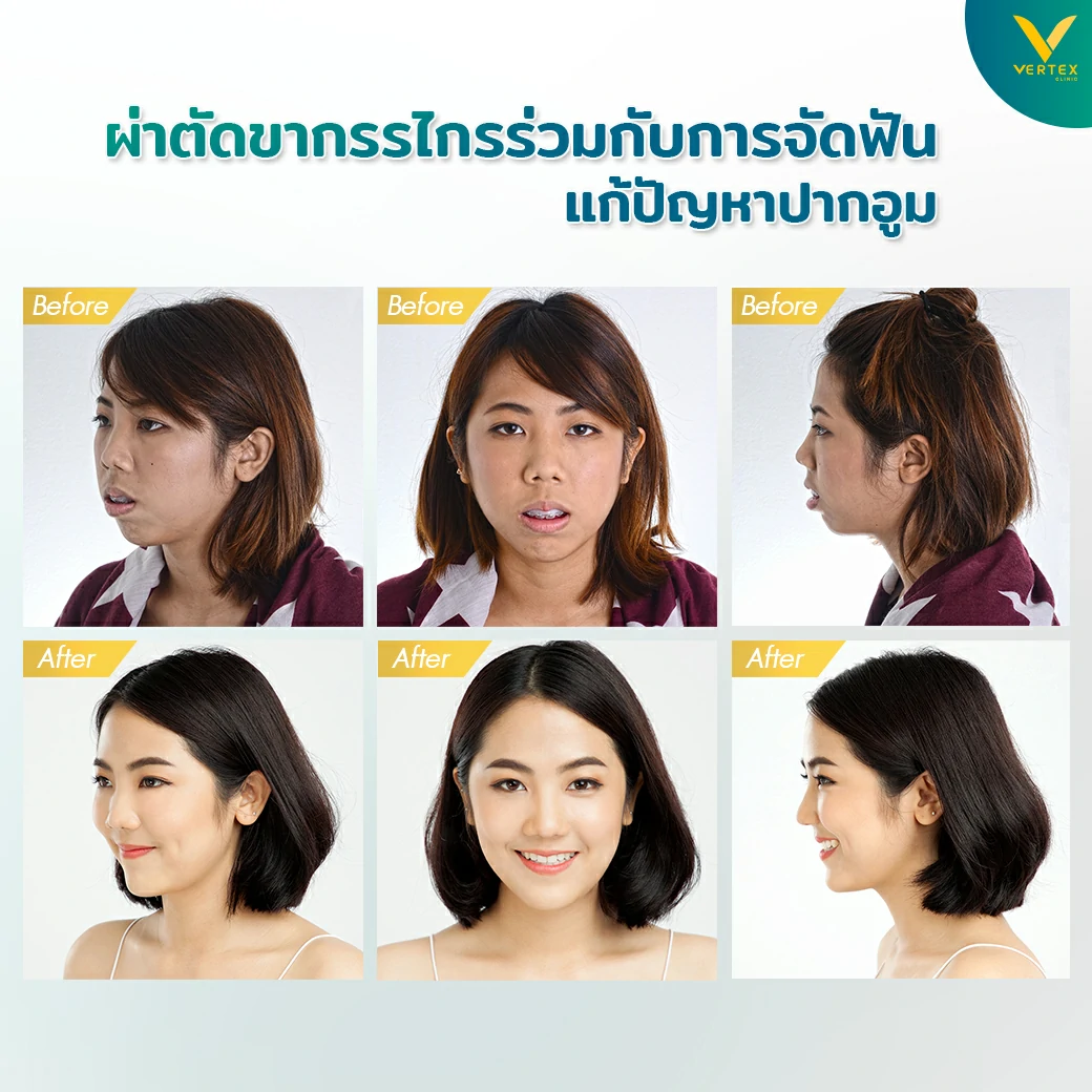 ผ่าตัดแก้ปากอูม คุณจิรดา