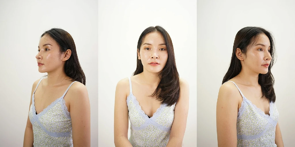 หลังผ่าตัดกราม 6 เดือน