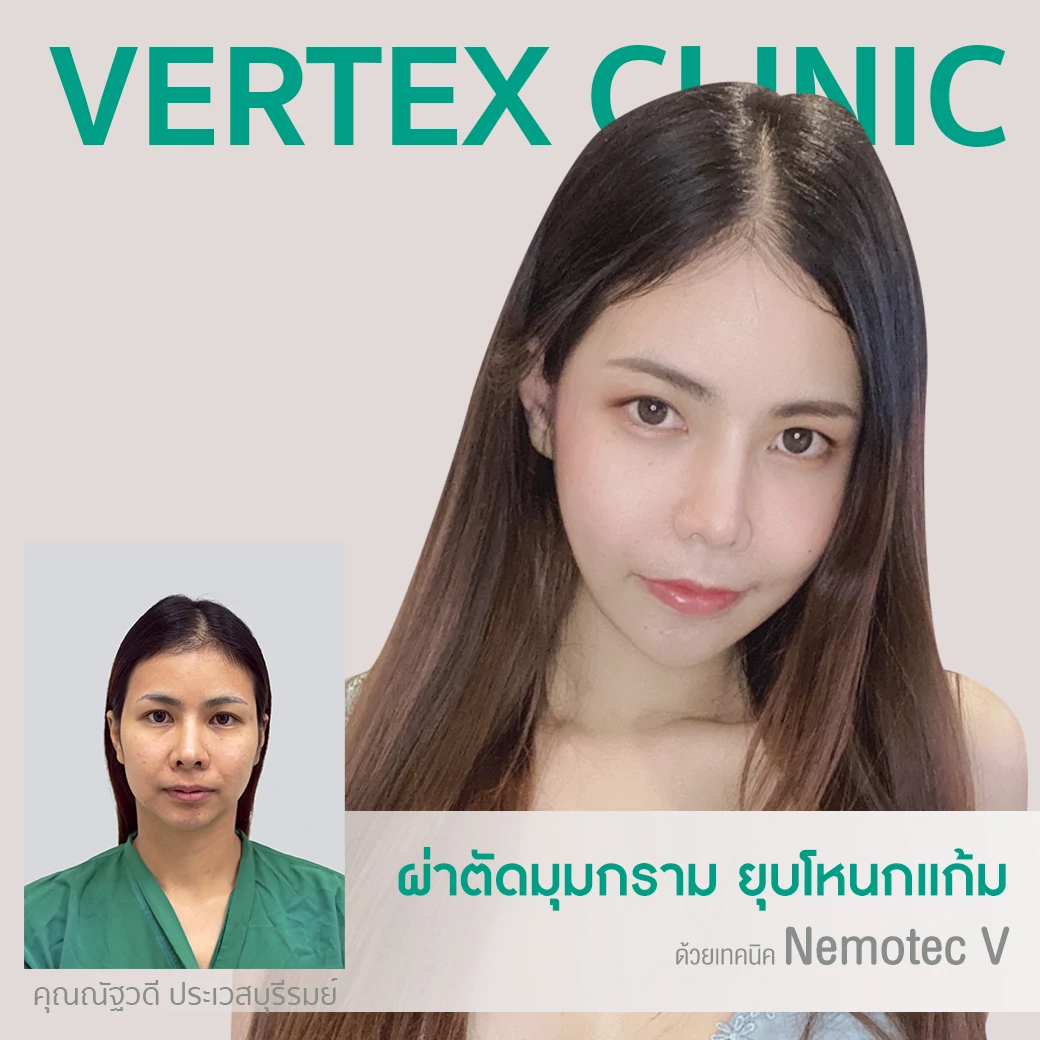 ศัลยกรรมผ่าตัดมุมกราม ลดกราม หน้าเรียว