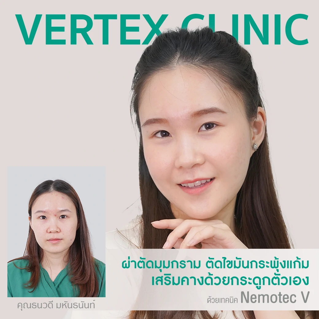 ศัลยกรรมผ่าตัดมุมกราม ลดกราม หน้าเรียว