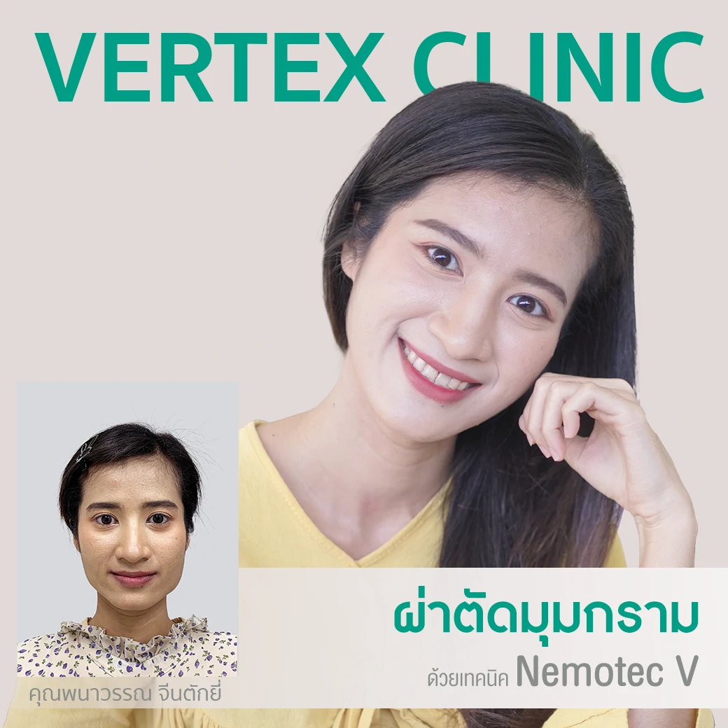 ศัลยกรรมผ่าตัดมุมกราม ลดกราม หน้าเรียว