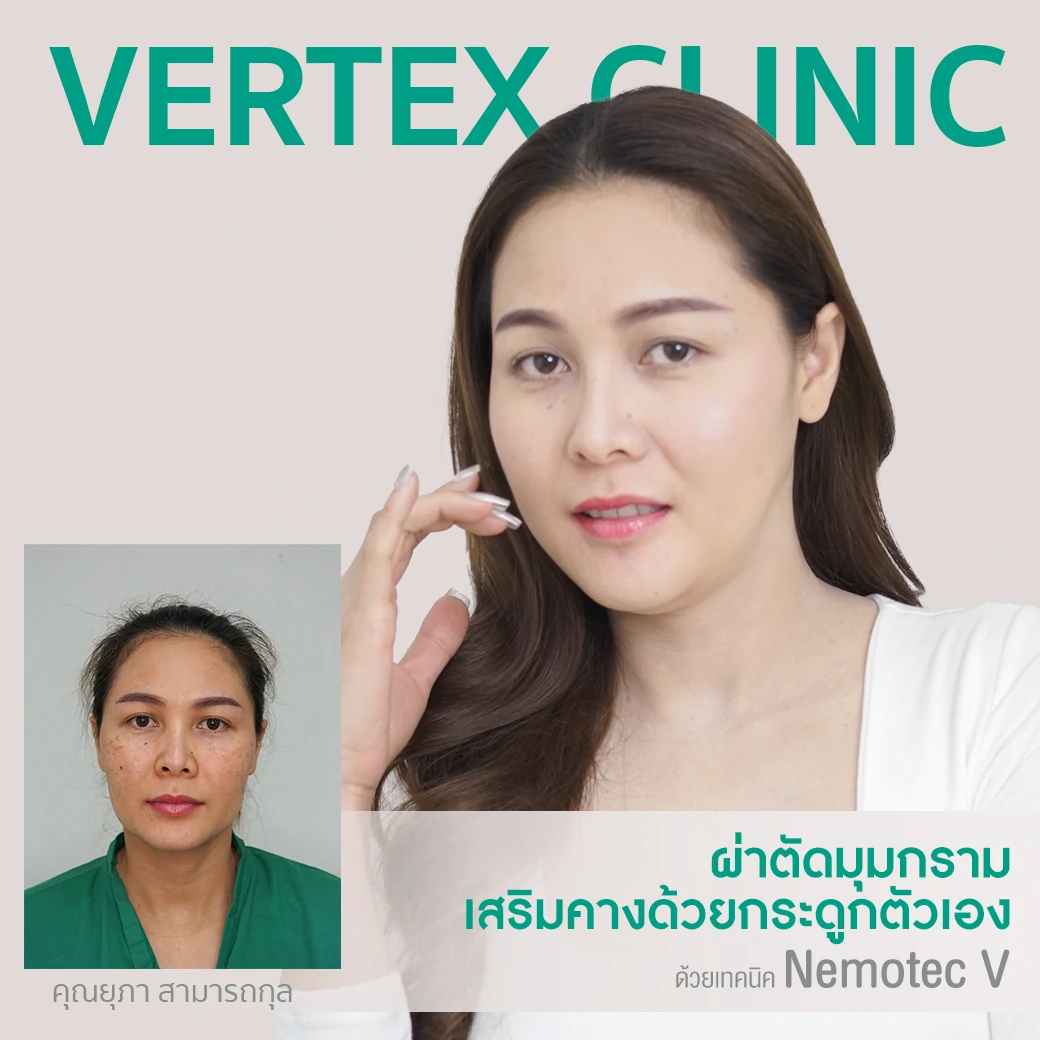 ศัลยกรรมผ่าตัดมุมกราม ลดกราม หน้าเรียว