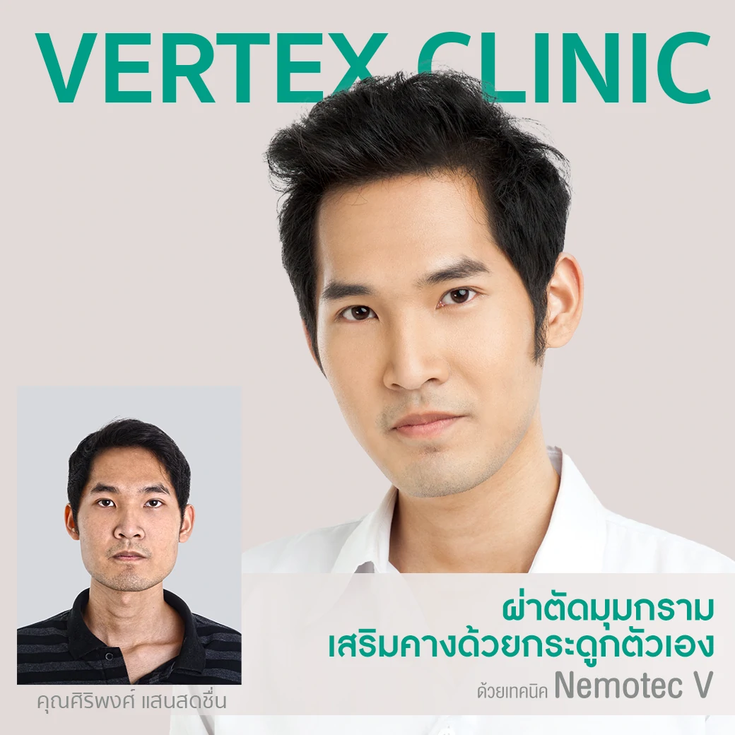 ศัลยกรรมผ่าตัดมุมกราม ลดกราม หน้าเรียว