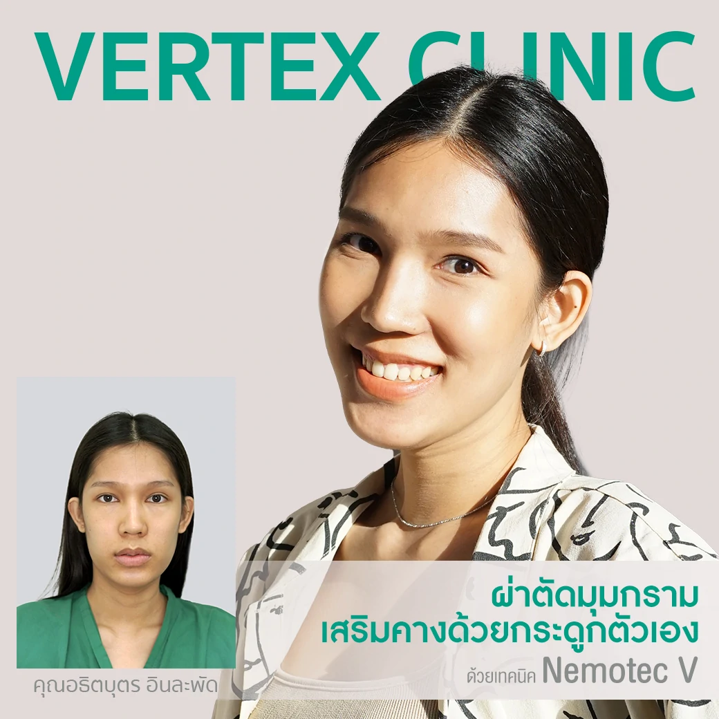 ศัลยกรรมผ่าตัดมุมกราม ลดกราม หน้าเรียว