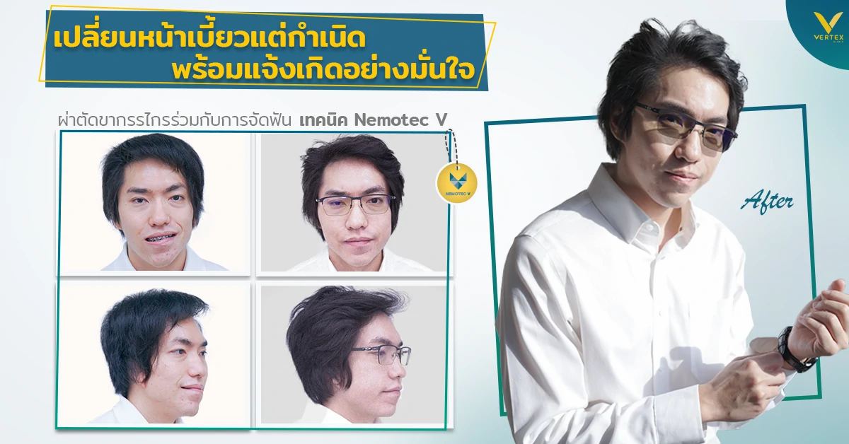 [รีวิวผ่าขากรรไกร] เปลี่ยนหน้าเบี้ยวแต่กำเนิด พร้อมแจ้งเกิดอย่างมั่นใจ ผ่าตัดขากรรไกรร่วมกับการจัดฟัน เทคนิค Nemotec V
