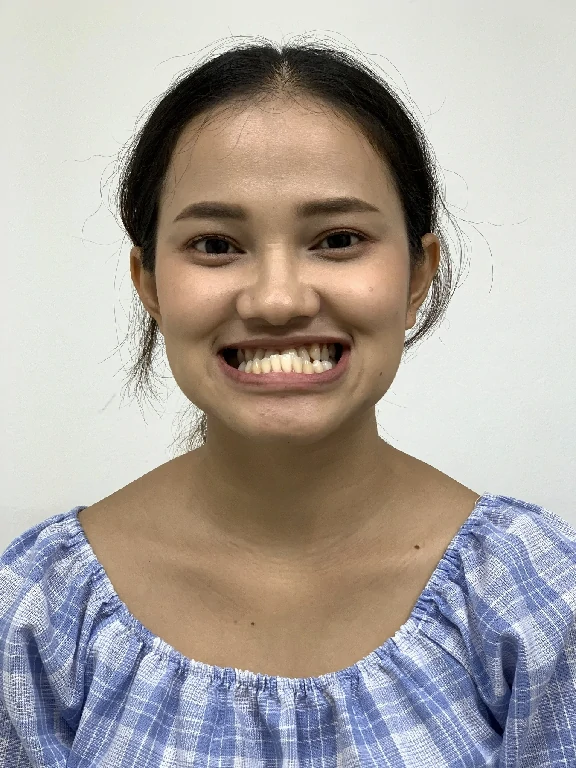 ผ่าตัดขากรรไกร ผ่าขากรรไกร ขากรรไกร รีวิวฟันล่างคร่อมฟันบน คางยื่น