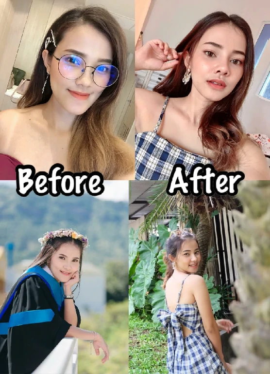 ผ่าตัดขากรรไกร ผ่าขากรรไกร ขากรรไกรรีวิว ฟันล่างคร่อมฟันบน คางยื่น