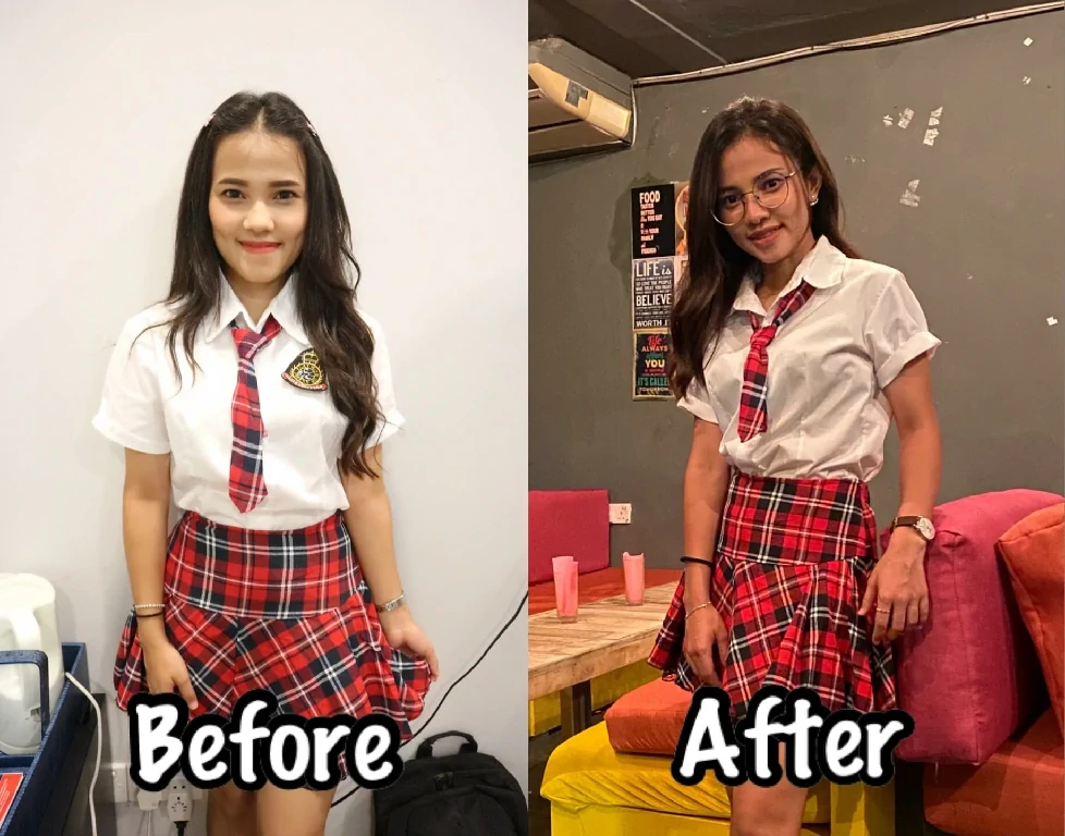 รีวิวผ่าตัดขากรรไกร รีวิวผ่าขากรรไกร ขากรรไกร ฟันล่างคร่อมฟันบน คางยื่น