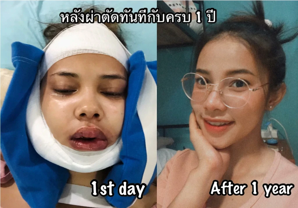 รีวิวผ่าตัดขากรรไกร รีวิวผ่าขากรรไกร รีวิวขากรรไกร รีวิวฟันล่างคร่อมฟันบน รีวิวคางยื่น