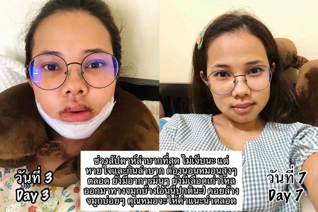 รีวิวผ่าตัดขากรรไกร รีวิวผ่าขากรรไกร