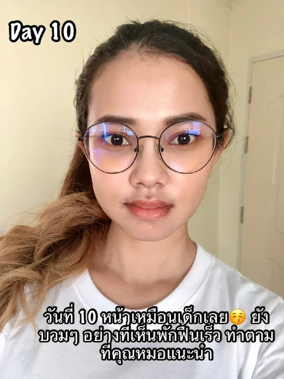ผ่าตัดขากรรไกร ผ่าขากรรไกร