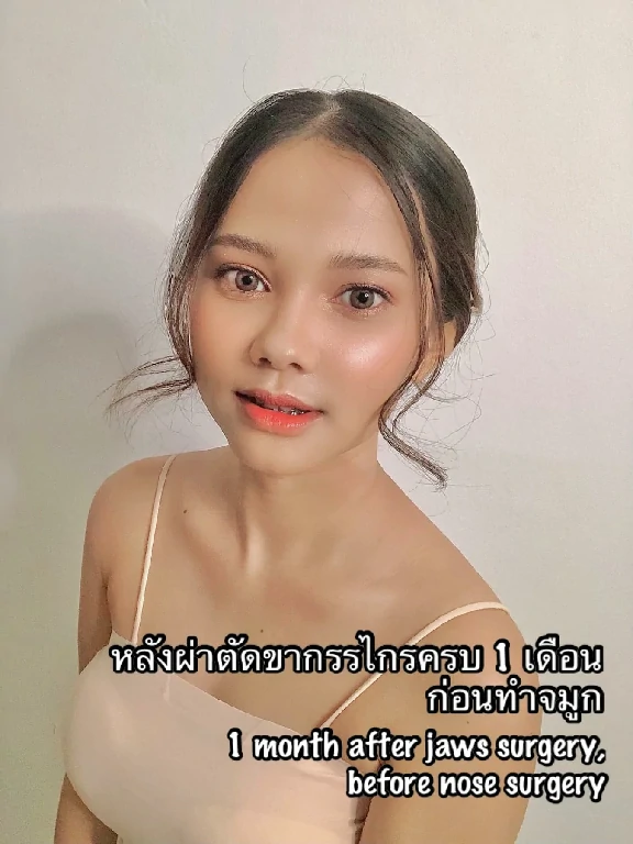 ผ่าขากรรไกร ขากรรไกร ฟันล่างคร่อมฟันบน คางยื่น