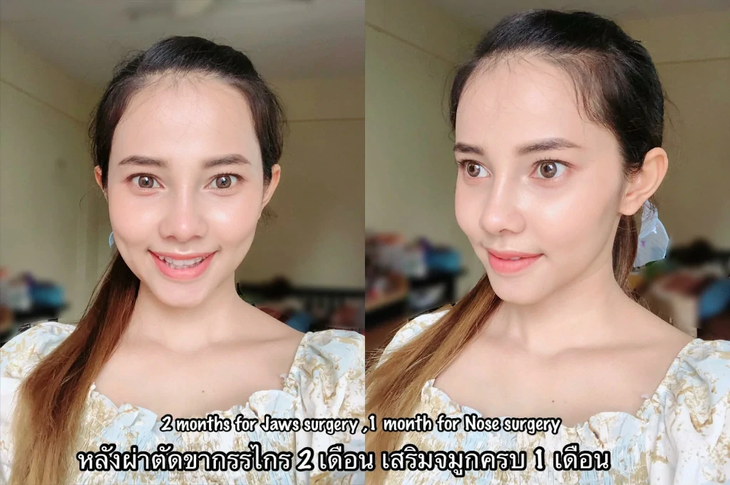 ผ่าตัดขากรรไกร ขากรรไกร ฟันล่างคร่อมฟันบน คางยื่น