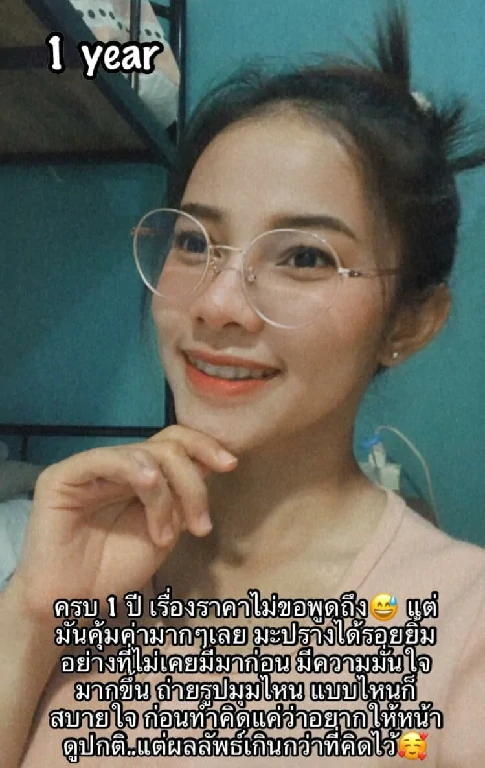 คางยื่น รีวิวฟันล่างคร่อมฟันบน ขากรรไกร ผ่าขากรรไกร ผ่าตัดขากรรไกร