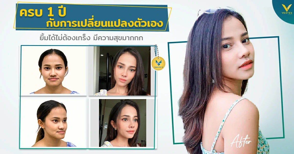 [รีวิวผ่าตัดขากรรไกร] ครบ 1 ปี กับการเปลี่ยนแปลงตัวเอง ยิ้มได้ไม่ต้องเกร็ง มีความสุขมาก!