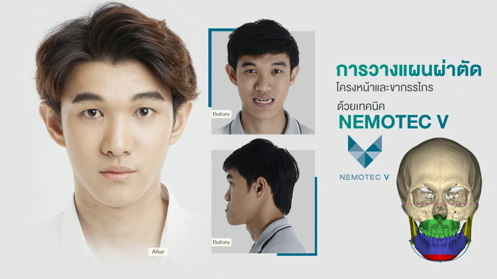 ผ่าตัดขากรรไกร