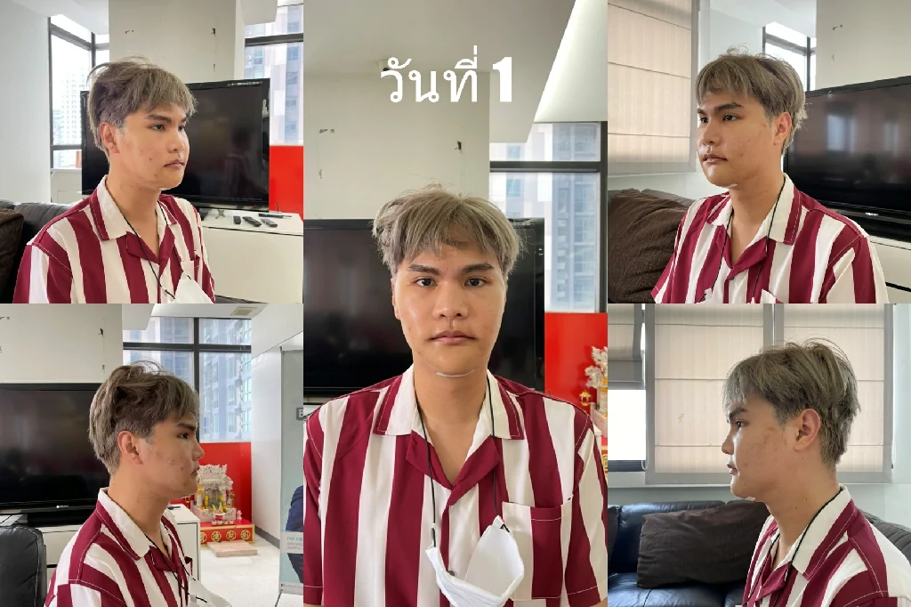 ตัดกรามทุบโหนกที่ไหนดี รีวิวทุบโหนก ตัดกรามตัดโหนกแก้ม