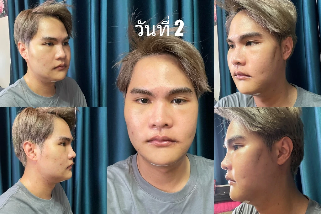 ผ่าตัดกรามที่ไหนดี ยุบโหนกตัดกราม ผ่าตัดมุมกราม