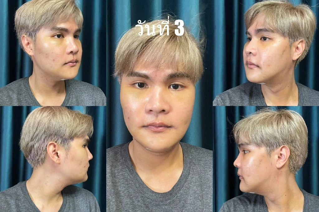 ยุบโหนกตัดกราม ผ่าตัดมุมกราม