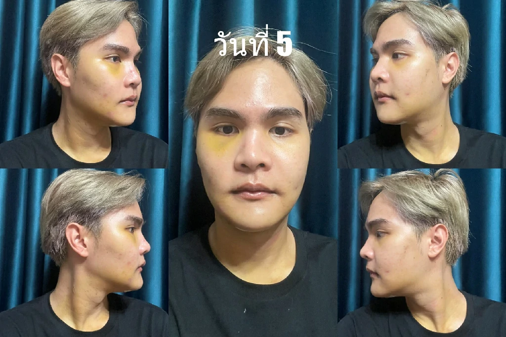 ตัดกรามตัดโหนกแก้ม รีวิวทุบโหนก ผ่าตัดกรามที่ไหนดี