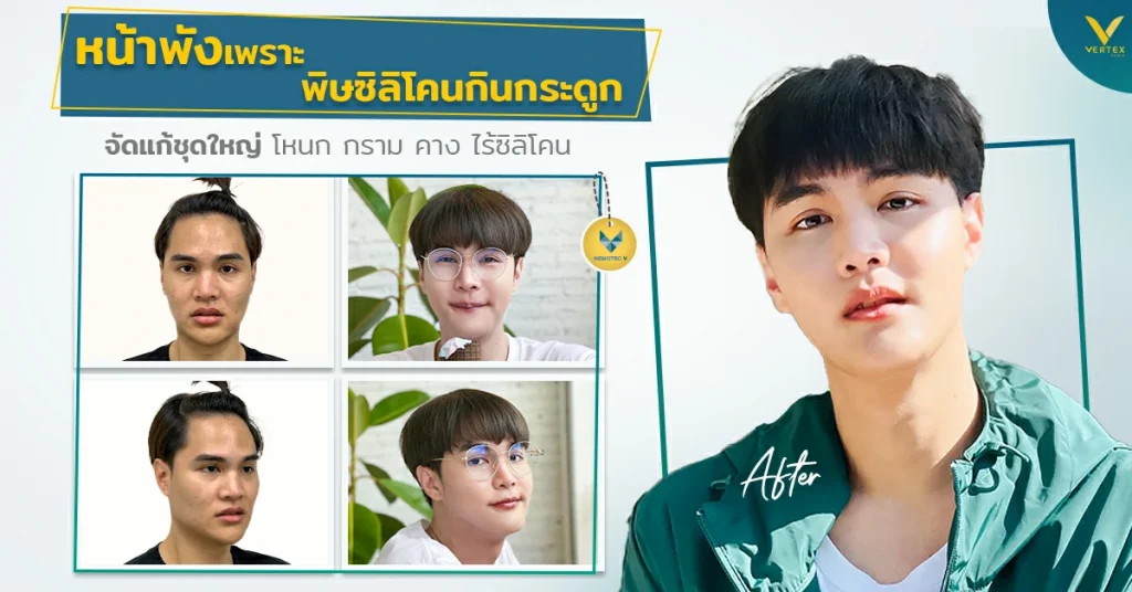 หน้าพังเพราะพิษซิลิโคนกินกระดูก จัดแก้ชุดใหญ่ โหนก กราม คาง ไร้ซิลิโคน