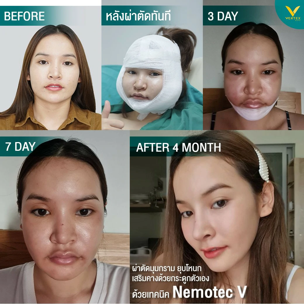 ทําวีไลน์ วีไลน์ รีวิววีไลน์ในไทย ศัลยกรรม v-line ศัลยกรรมวีไลน์