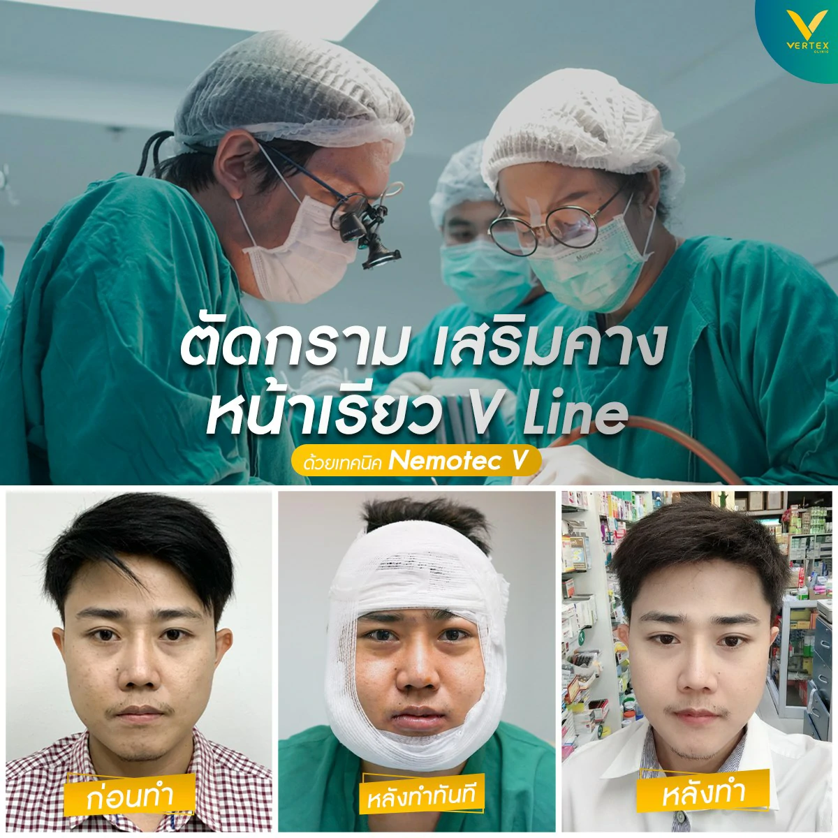 v line ทำวีไลน์ ศัลยกรรมวีไลน์ มินิวีไลน์ ตัดกราม วีไลน์