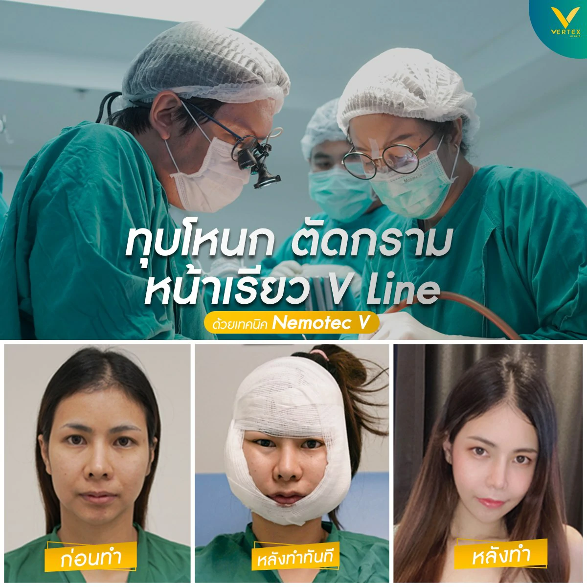 รีวิววีไลน์ วีไลน์ในไทย ศัลยกรรม v-line ศัลยกรรมวีไลน์ ทําวีไลน์