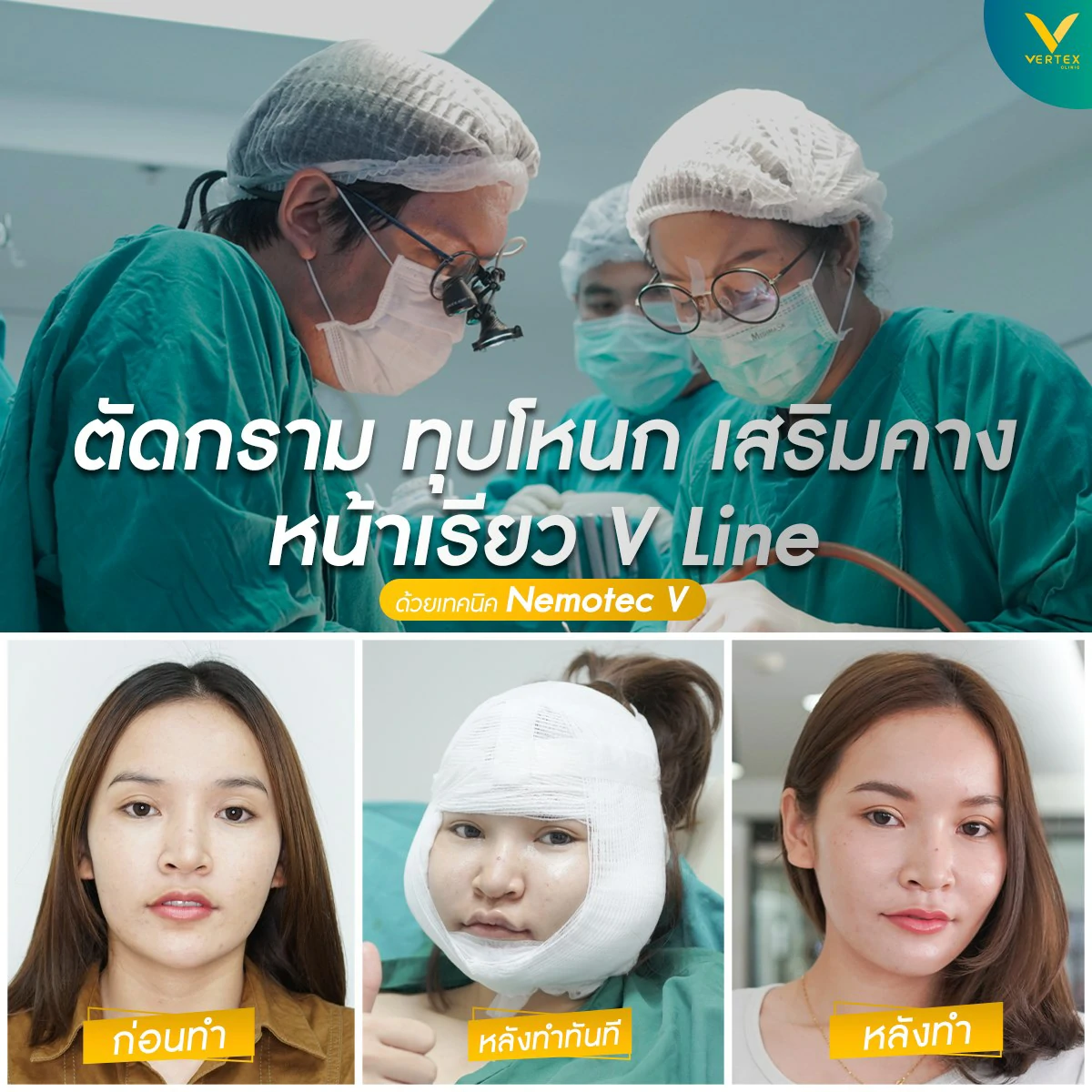 วีไลน์ วีไลน์ในไทย ศัลยกรรม v-line ศัลยกรรมวีไลน์ รีวิวทําวีไลน์