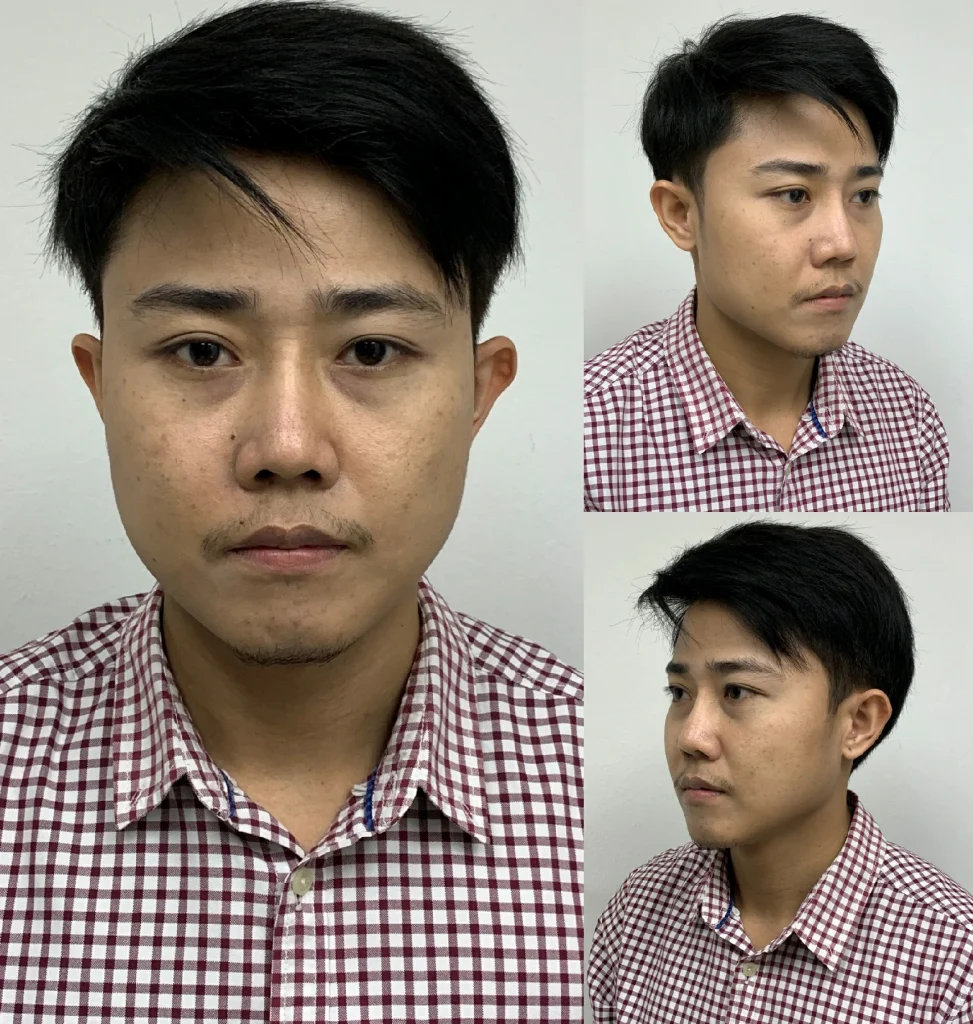 รีวิวตัดกราม ตัดกล้ามเนื้อกราม เสริมคางปรับคางสั้น หน้าเรียวหล่อมั่นใจ รีวิวตัดกราม ตัดกล้ามเนื้อกราม เสริมคางปรับคางสั้น หน้าเรียวหล่อมั่นใจ