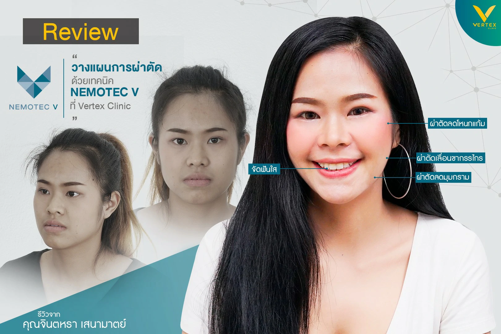 รีวิววีไลน์ วีไลน์รีวิว รีวิวทำวีไลน์ รีวิวศัลยกรรมวีไลน์