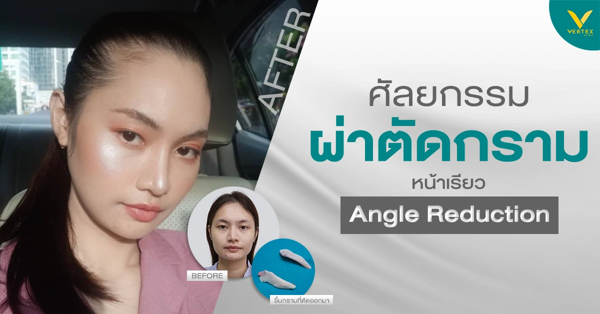 ผ่าตัดกราม แบบธรรมดา