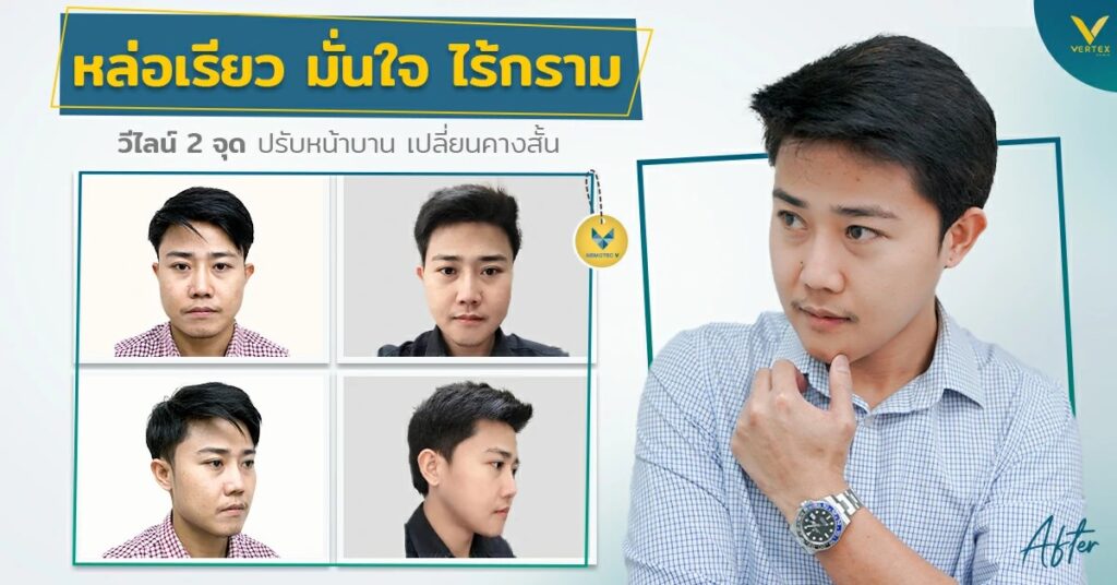 รีวิววีไลน์-ตัดกรามผู้ชาย