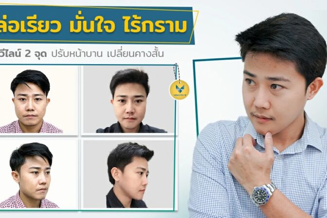 [รีวิวตัดกราม+เสริมคาง+ตัดกล้ามเนื้อกราม] ปรับหน้าบาน เปลี่ยนคางสั้น ได้หน้าหล่อเรียวมั่นใจ ใครว่าผู้ชายไม่อยากหล่อ