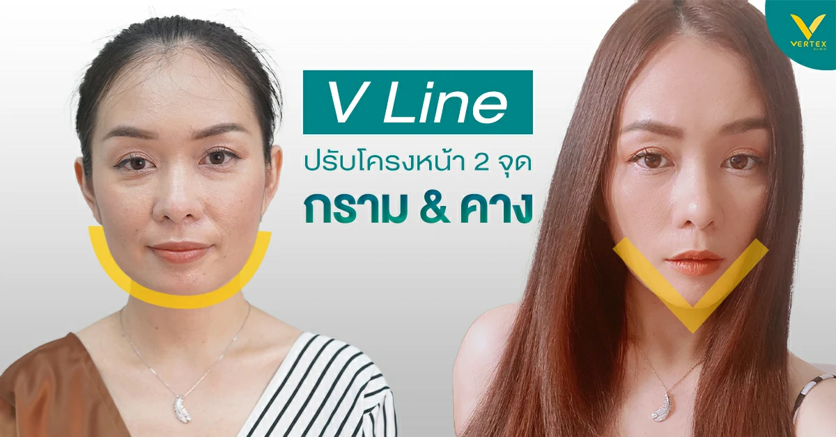 ตัดกรามวีไลน์