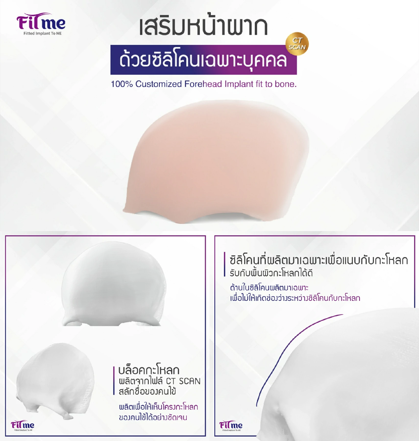 เสริมหน้าผากซิลิโคน ทำหน้าผาก เสริมหน้าผากที่ไหนดี ศัลยกรรมหน้าผาก