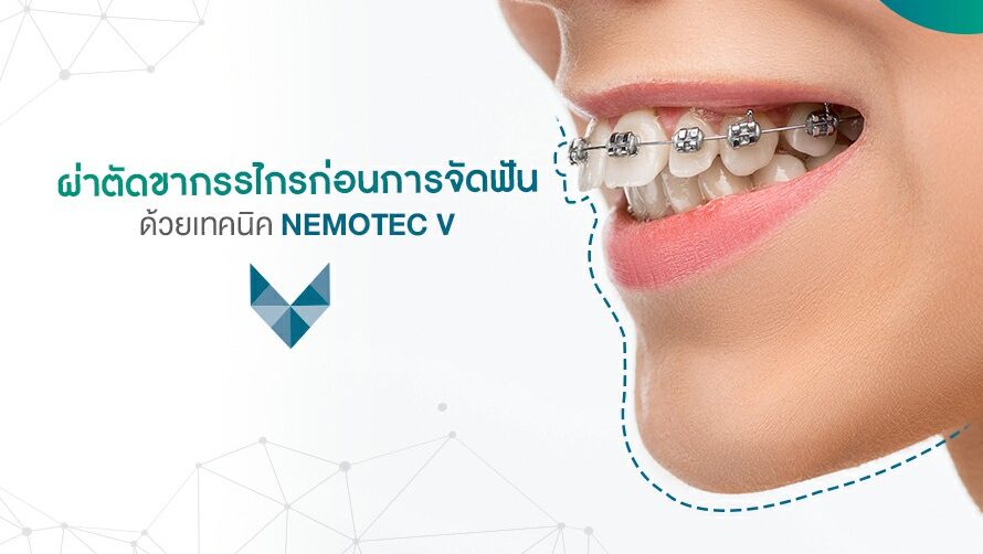 ผ่าขากรรไกรก่อนการจัดฟันด้วย Nemotec V