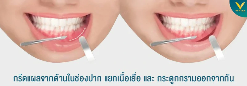 ผ่ากรามเปิดแผลในช่องปาก เปิดแผลบริเวณไหน